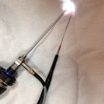 レーザーで花粉症の症状を抑えられるって本当?気になる副作用や費用を要チェック!